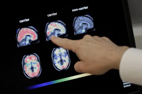 Alzheimer’s drug nod amid efficacy debate