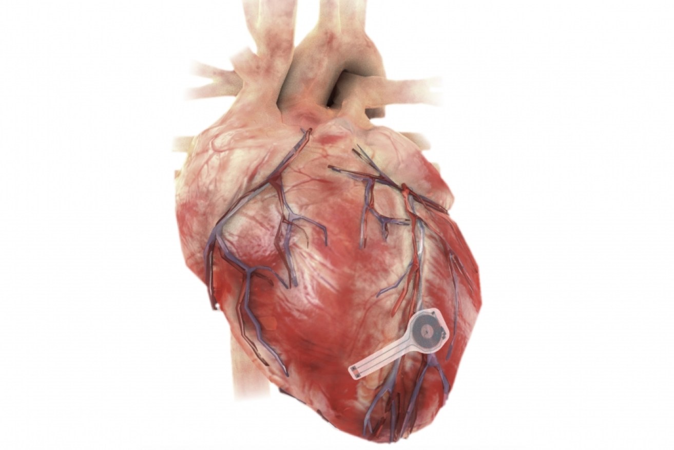 A new pacemaker that dissolves when it's no longer needed could spark a 'bioresorbable' boom. 