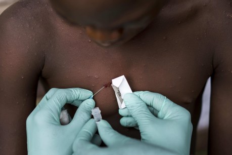 Mass monkeypox vaccines not urgent: WHO