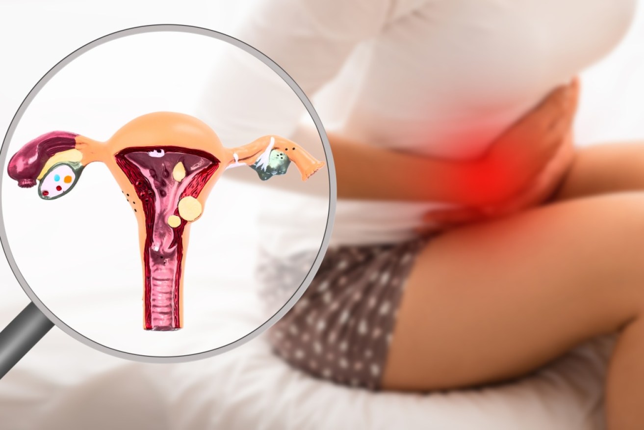 Every month, periods lead to more scarring in women with endometriosis. 