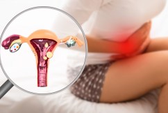 New hope for women suffering endometriosis