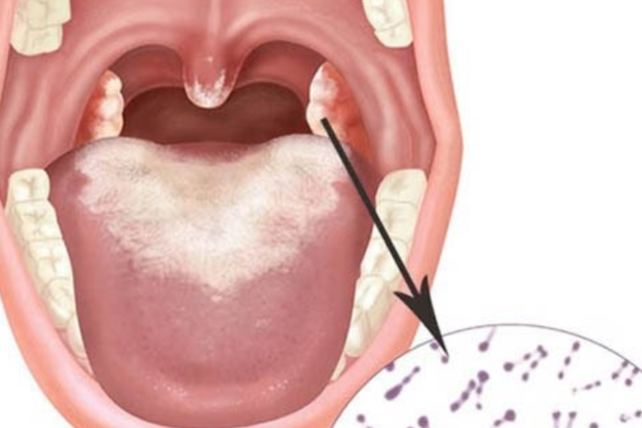 The bacteria colonises the mouth and throat, placing a white film across airwaves that can inhibit breathing. <i> Art: getdoc</i>