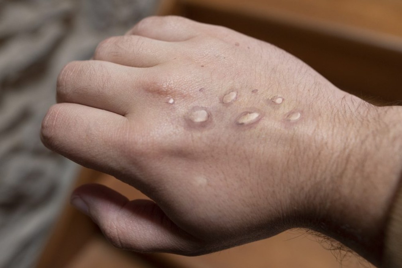 Skin lesions are among the symptoms of monkeypox.