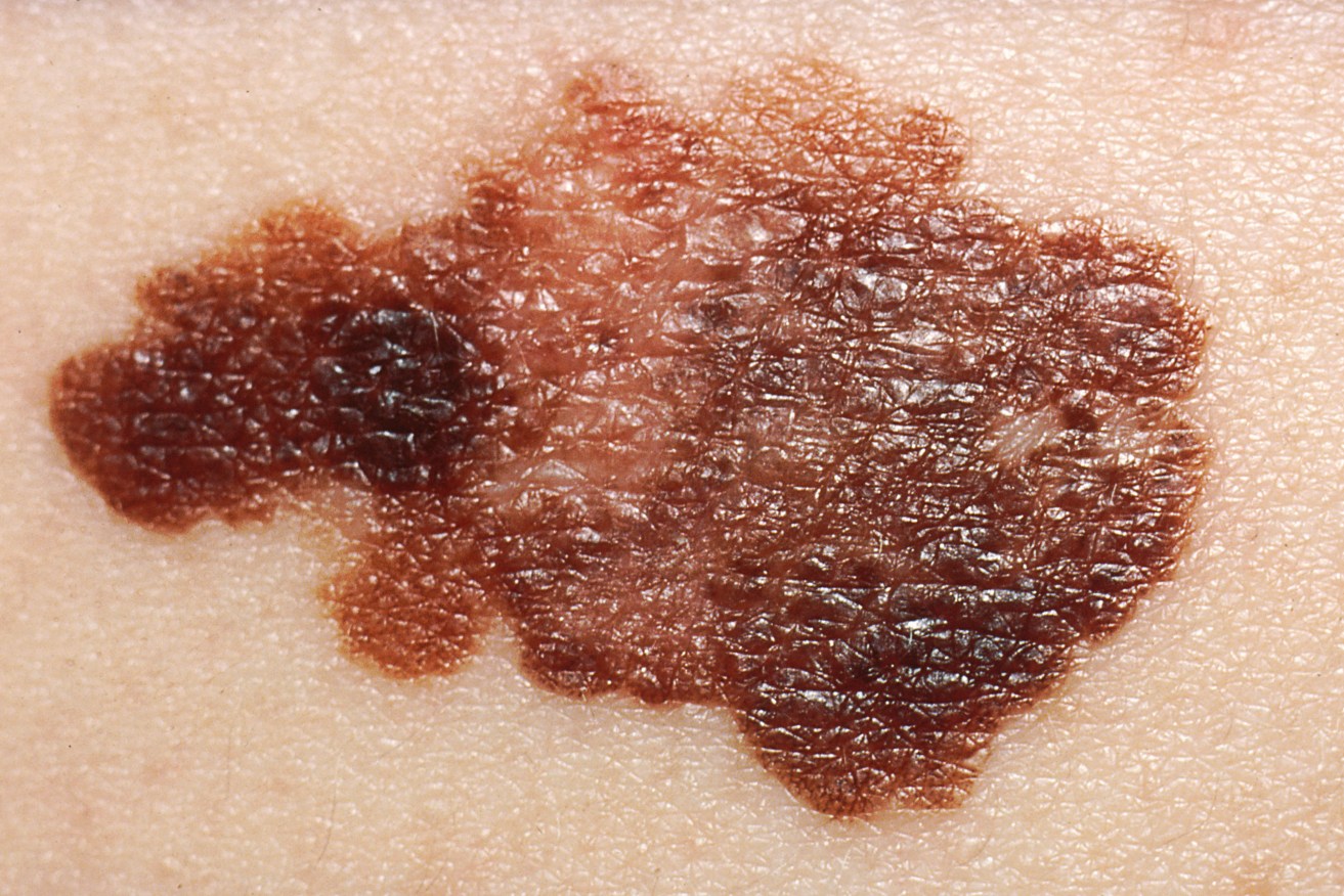 The problem with melanoma, it's not just skin deep. 