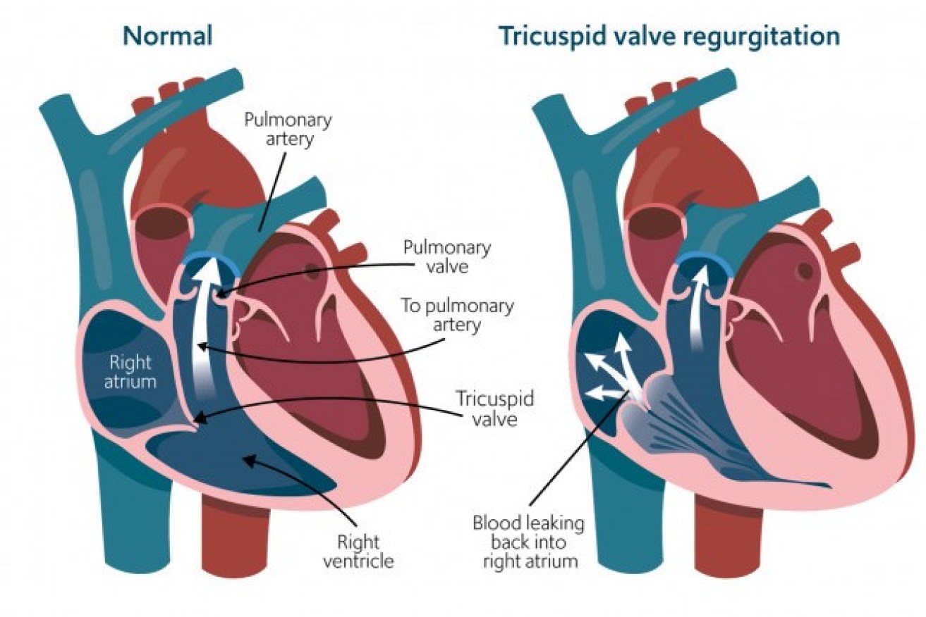 A leaky tricuspid valve causes fluid to  accumulate in vital organs. The eventual outcome is kidney and heart failure.