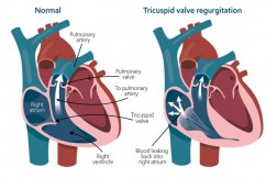 Forgotten heart valve: New treatment for nasty killer