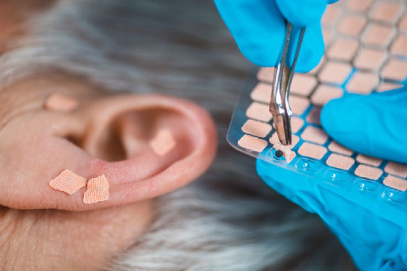 Evidence is accumulating that taping six metal beads to specific points on the ear helps weight loss.