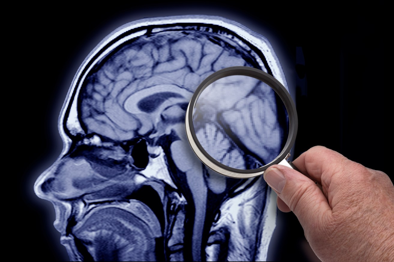 Does the Alzheimer's brain need to be looked at differently if we're to cure the disease?