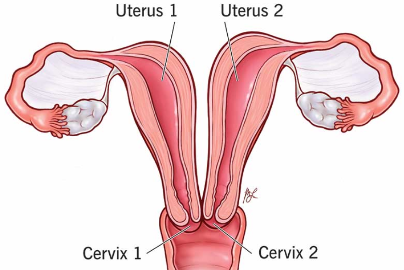 A double uterus is rare, and a twin from each even rarer.