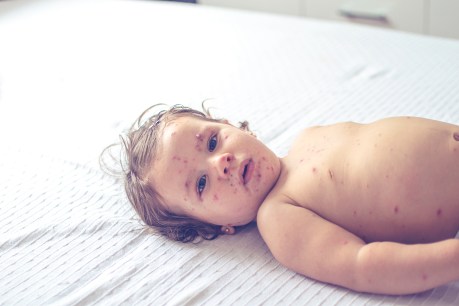 Measles: Why two babies put health officials on edge