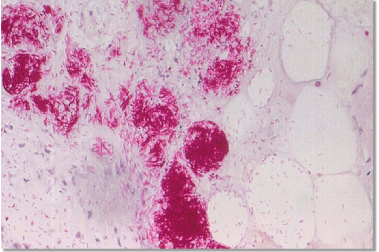 Flesh-eating Buruli bacteria needs to be diagnosed early. For one woman it took four months. 