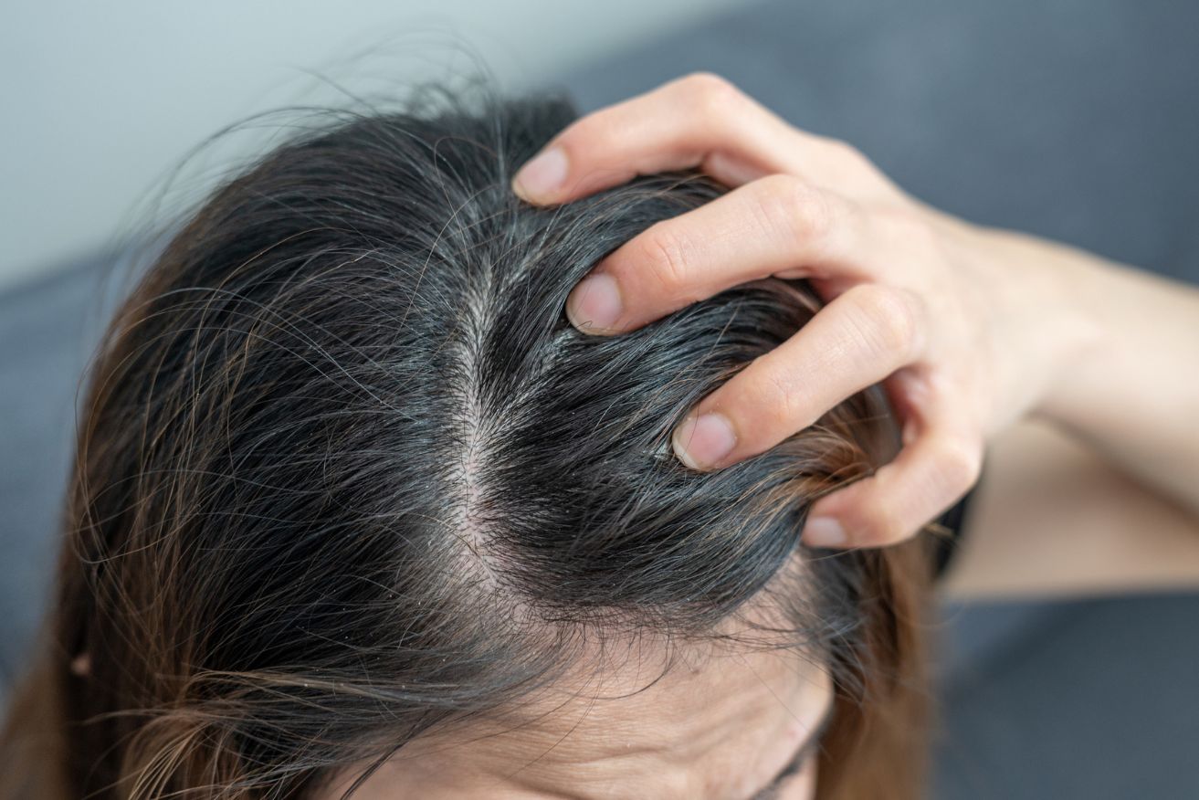 The itchiness associated with dry scalp isn't usually severe.