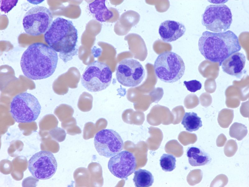 leukemia