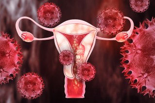 Doctors urge checks as endometrial cancer rises