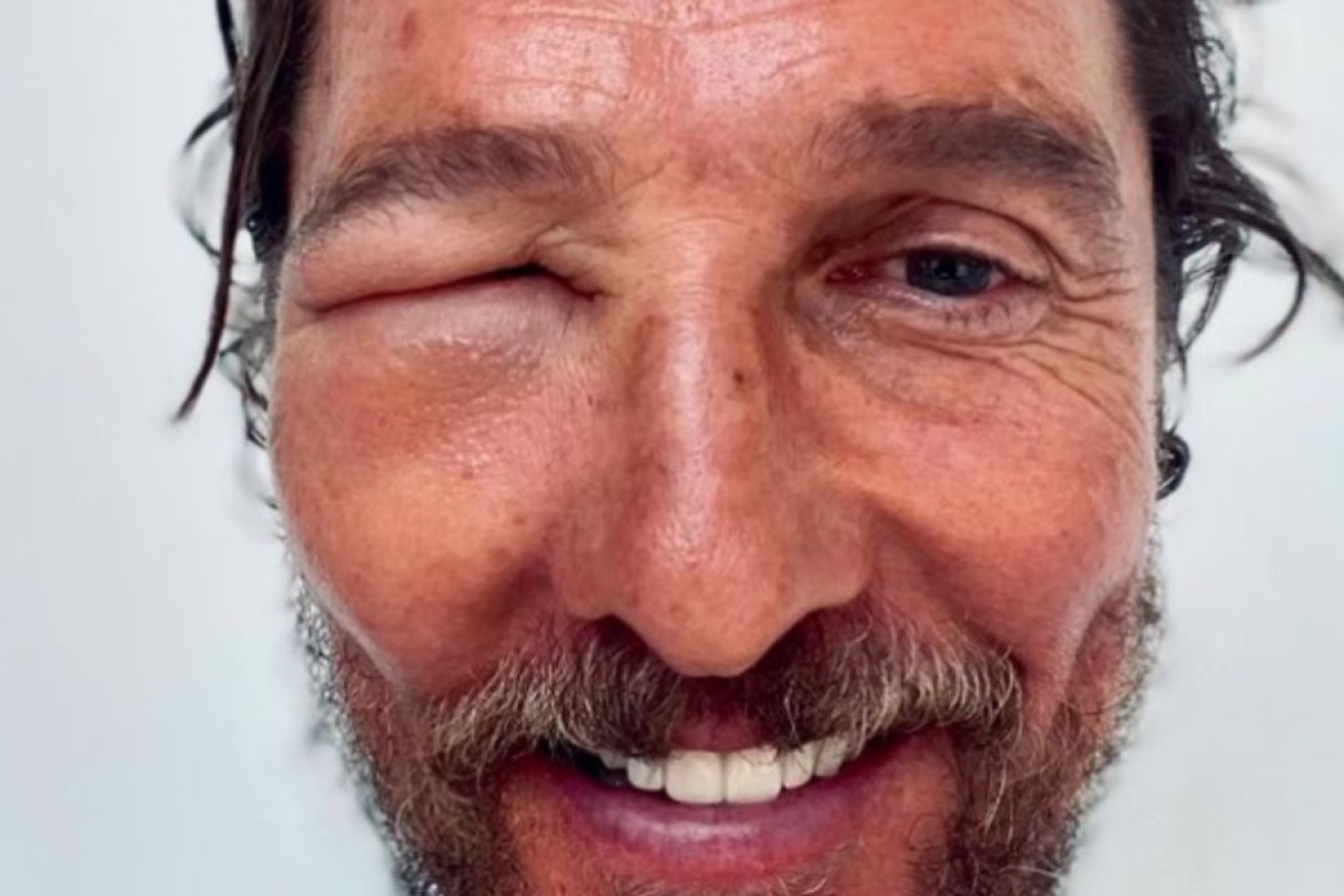 A swollen-faced Matthew McConaughey after being stung by a bee.