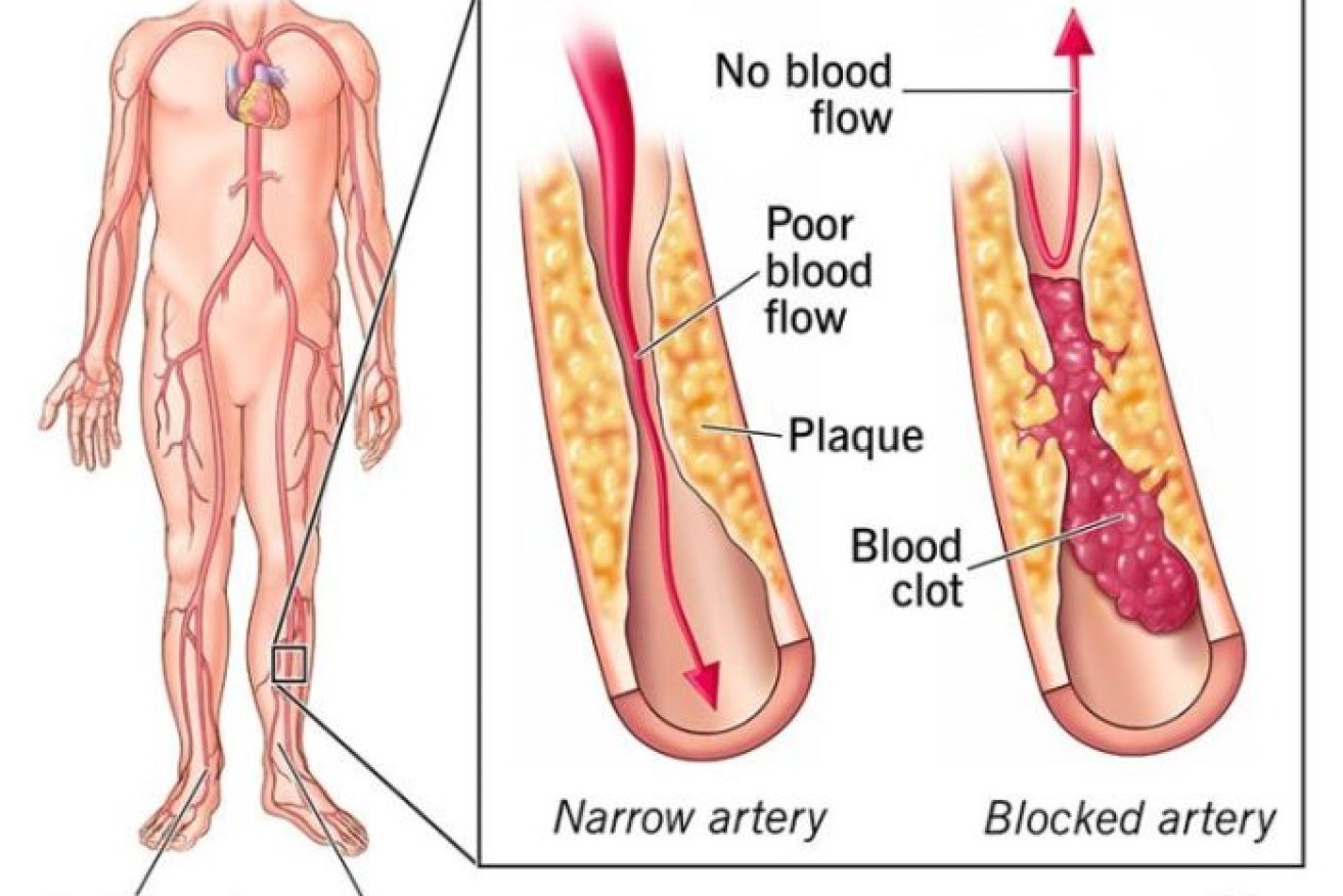 Peripheral Artery Disease interrupts the blood flow to the legs. One in five Australians have the condition.