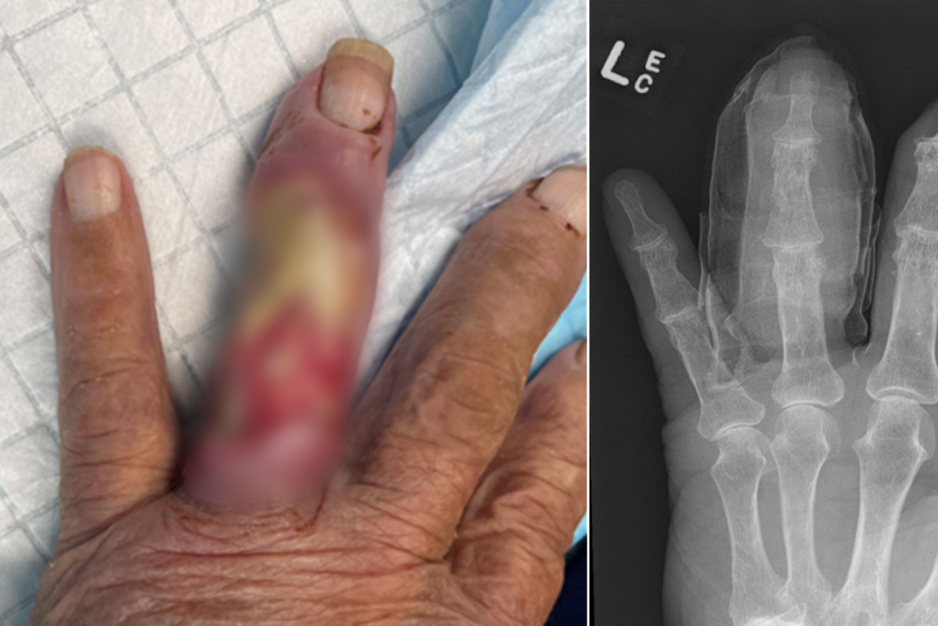 One man had his finger amputated after the spread of the ulcer.