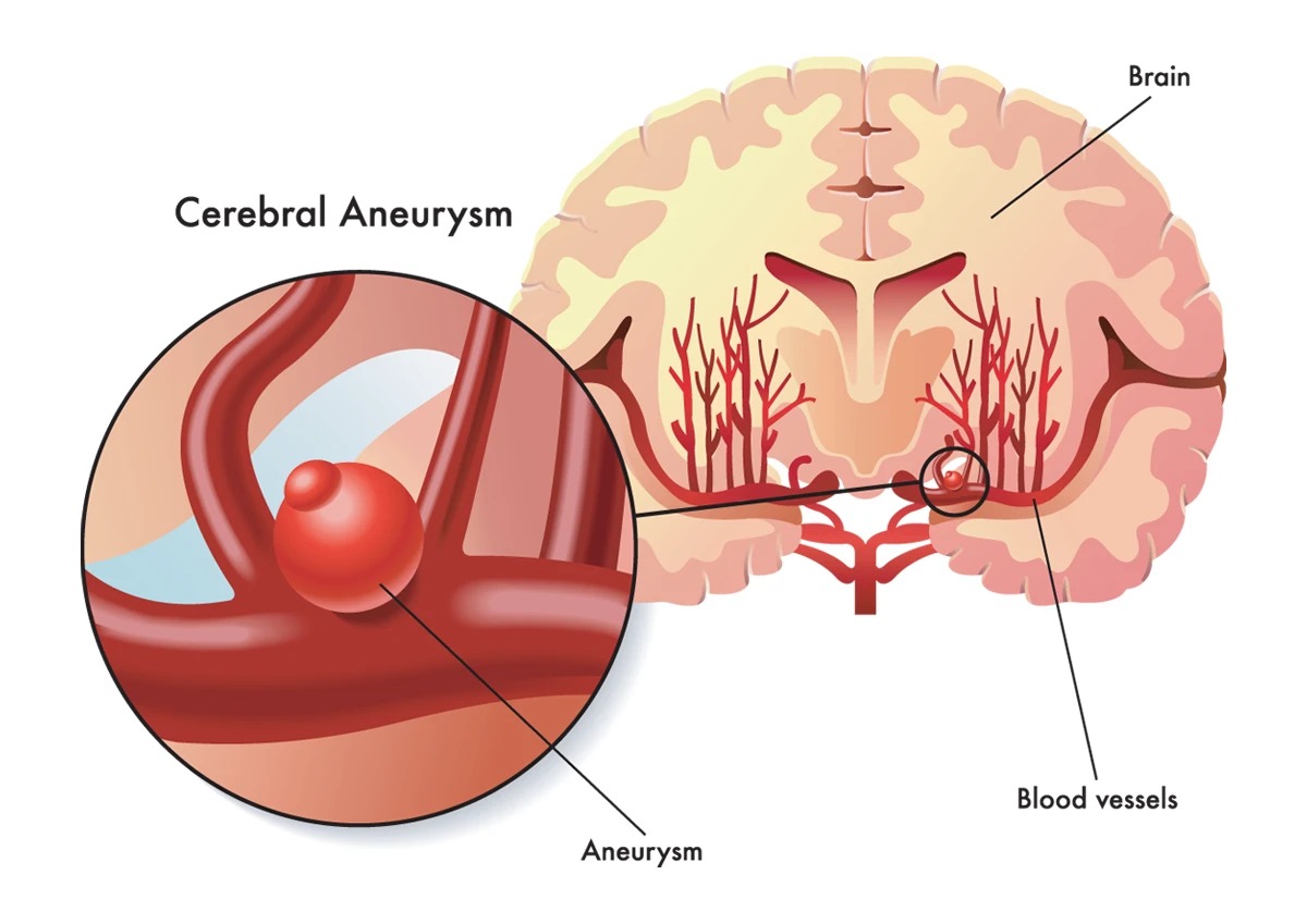 aneurysm