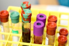 Off-switch found for known driver of prostate cancer