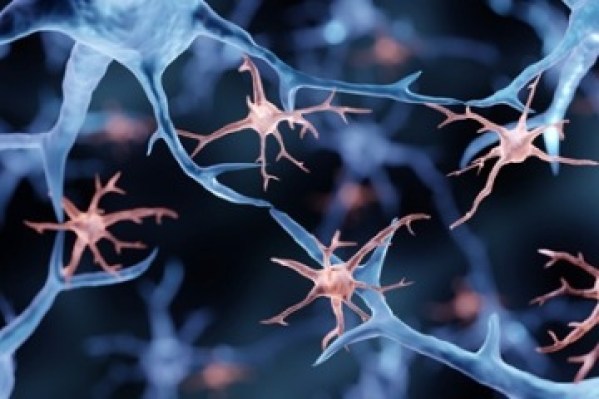 alzherimers