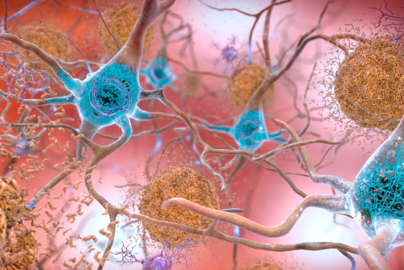 The drug also caused a notable decrease in amyloid plaque buildup, which is a hallmark of Alzheimer’s disease.