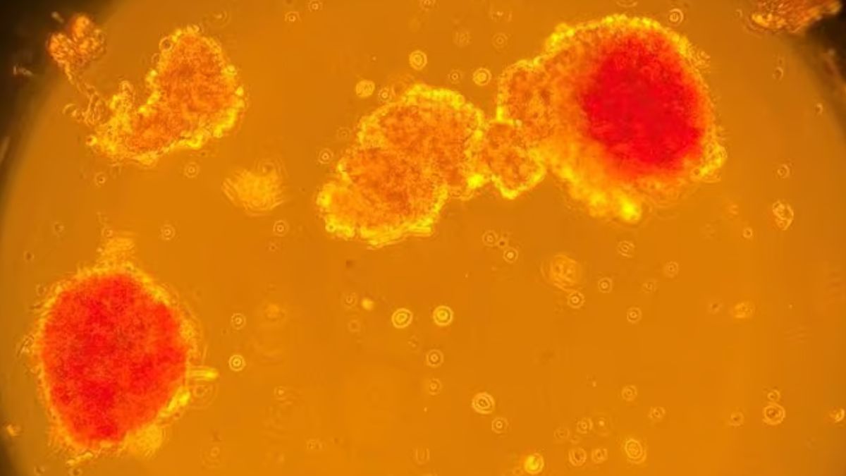 pancreas diabetes