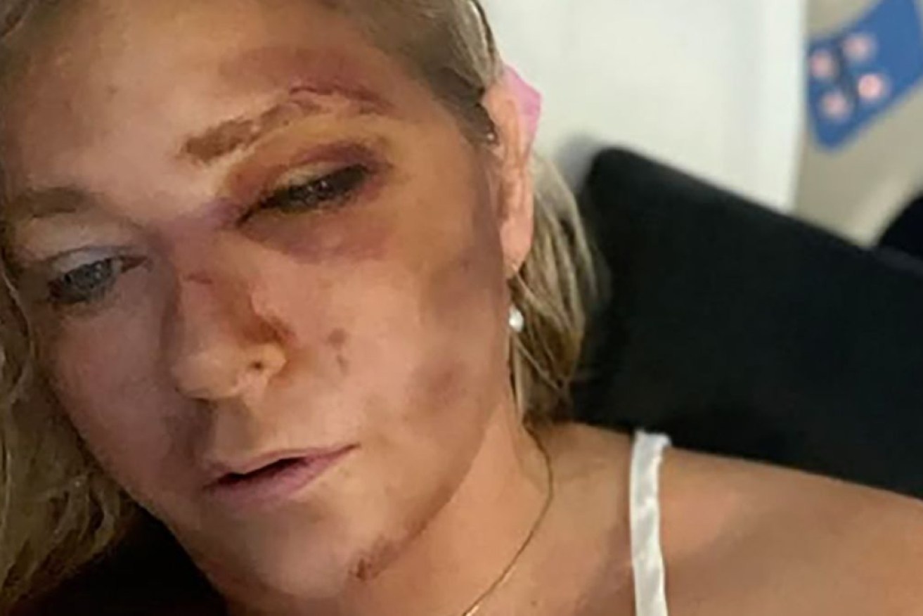 Virginia Giuffre posted a photo showing her face with what appeared to be extensive bruising.