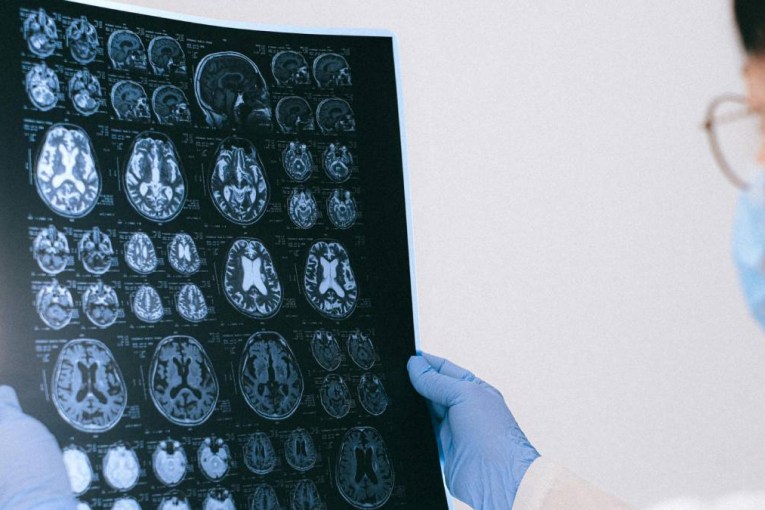 Brain disorder is no longer treated as ‘hysteria’