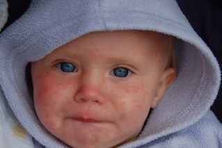 Measles: we’re on the precipice of a disaster, experts say