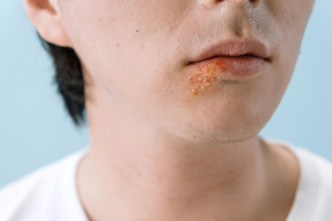 Cold sore-Alzheimer's link? Let's not panic just yet