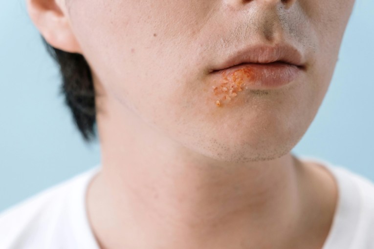 Cold sore-Alzheimer's link? Let's not panic just yet