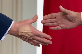 Doctor's verdict on Trump's swollen legs, bruises