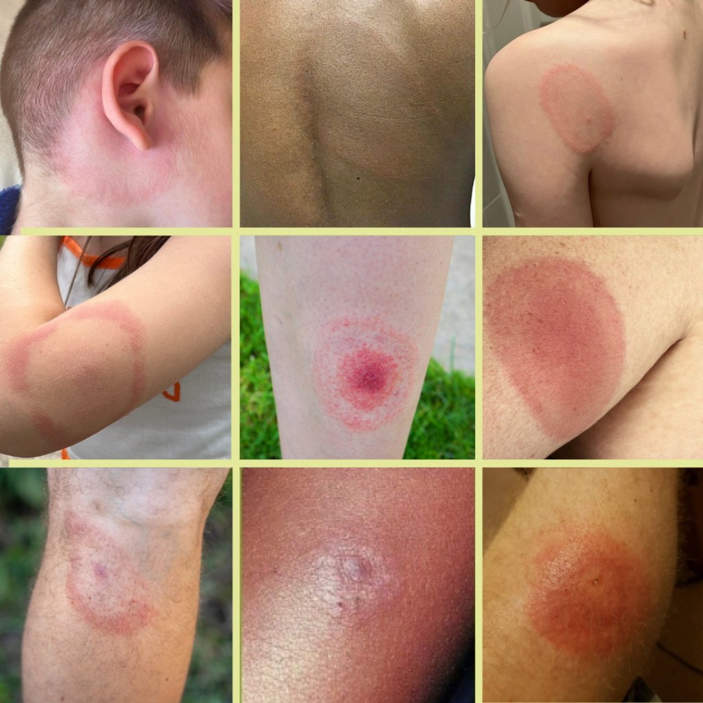 Lyme disease
