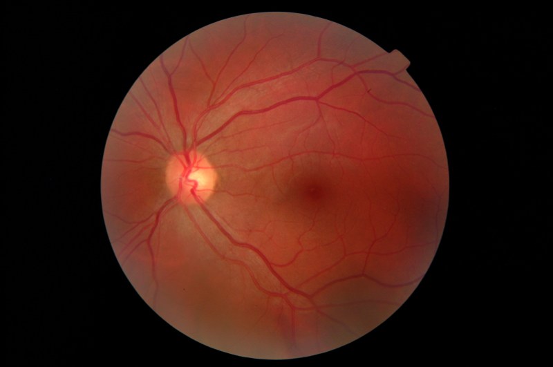 ai scans eyes