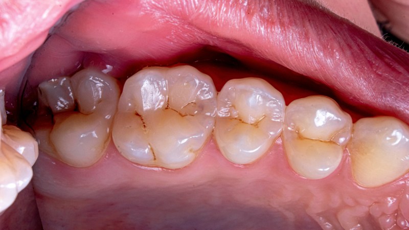 gingivitis