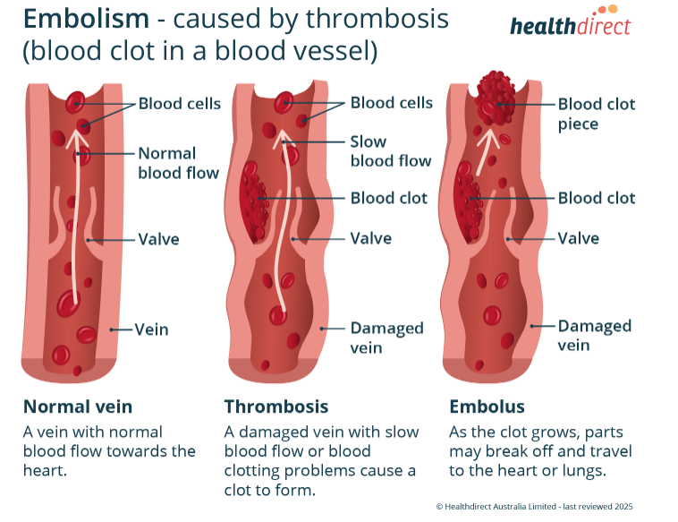 Embolism