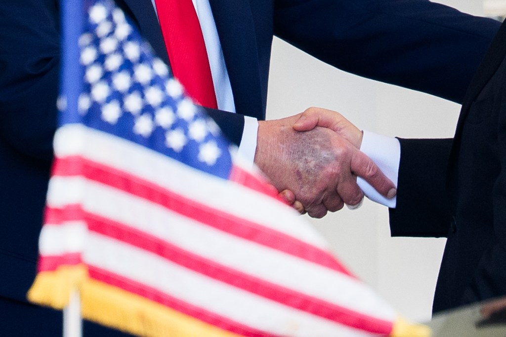 Donald Trump and bruise