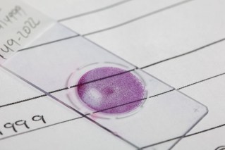 Cervical cancer elimination goal at risk as jabs fall