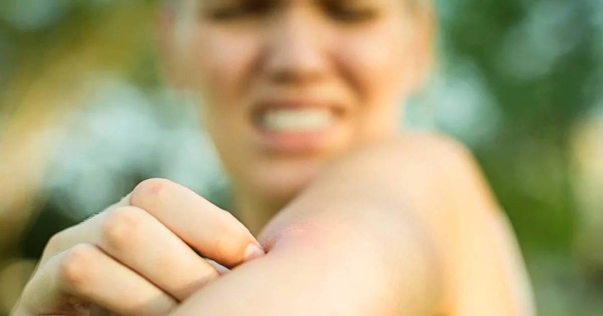 Why some people react so badly to mosquito bites